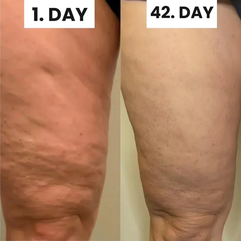 Alamaraat™ Cellulite Relief Kit