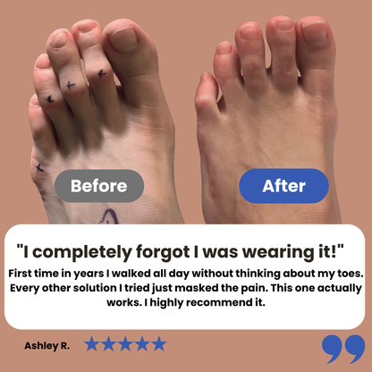 Foot Toe Corrector
