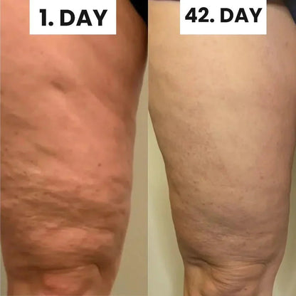 Alamaraat™ Cellulite Relief Kit